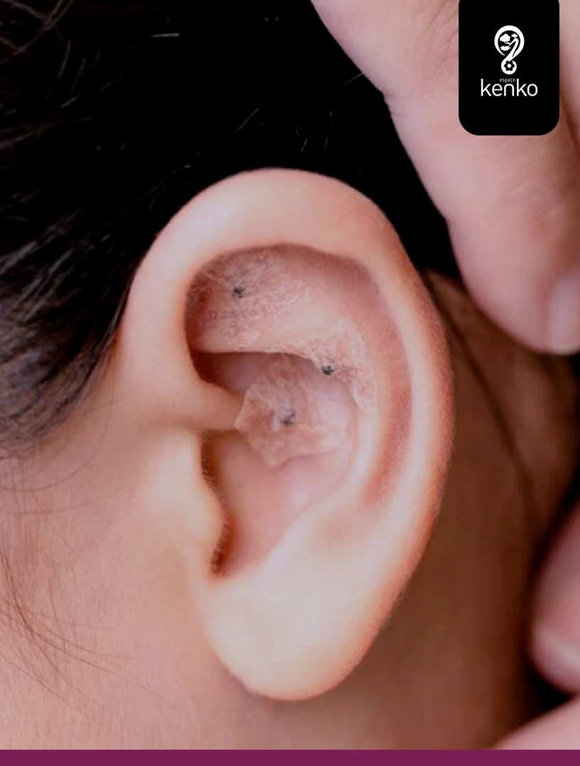 AURICULOTERAPIA 01